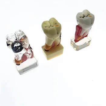 Model zuba 4-višekratnik model patologija zuba Integrirani Model Parodontne za učenje stomatologije i istraživačkih modela